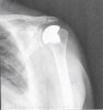 20211122 PED Left Shoulder XRay.jpg